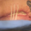 scar tear-day 2-right side