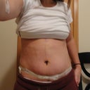 5 days post op (front)