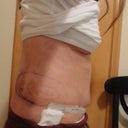 5 days post op (side)