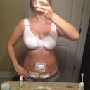 bruising from lipo on day of surgery...not as swollen as last time as there wasn't too much left to take out. looks like i wont have the big booty i always wanted but it's definitely an improvement