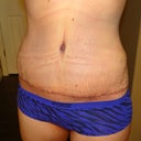 Post Op week 5 not much changed.