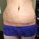 Incision using Dermatix Ultra.