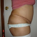 3 weeks 2 days post right
Really swollen... Was really ACTIVE today
Got My Period today so I could also be Bloated
