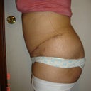 3 weeks 2 days post left
Really swollen... Was really ACTIVE today
Got My Period today so I could also be Bloated
