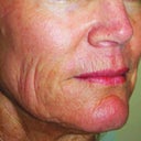 Fractional CO2 Laser