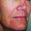 Fractional CO2 Laser