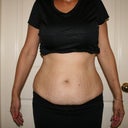 Before pic- night before surgery, looks like I'm pregnant YUCK