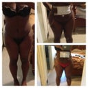 Before- post opt week 1 and the last one is post opt week 2. The bandage on my tummy is where I got burn at. I keep it cover at all times. And I use the crame the doc gave me