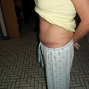 20 days op ( still a lot of swelling , i hope)