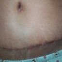 a close up of scar at 20 days