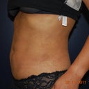 Side shot two months after lipo