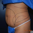 Side shot of stomach before surgery