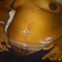 2 days po, swollen