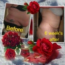 Befor TT & 6 week's After