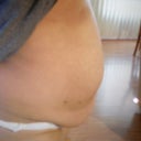 1 day prior to surgery