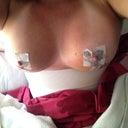500 CC's 6 days post op