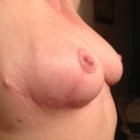 Right Side-3 Months. You can see the dog ear at the end of my scar.
