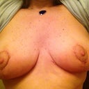 3/4 days after tape came off using new gel. First surgery (lift). Next surgery will make breasts even in size and shaped as I want.