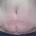 5 Weeks PO Front with Scar