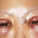 Day after surgery.  Eyes nearly swollen shut, undereye area swollen from fat removal and transfer through inner lid, undereye skin has been lasered to tighten