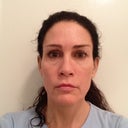 6 Weeks post first treatment