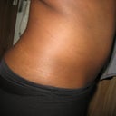 Day 1- After Procedure Side (swollen)