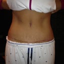 8 weeks, only 6 pounds down, but starting to go down more every week as healing continues and starting to go back to gym