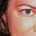 Pre-laser (this is a very bad picture, it doesn't show the extent of my scarring.)