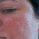 This is immediately after the laser treatment.  I was lying on the laser table still, this was before any ointment was put on.  Notice the cross-hatch marks.