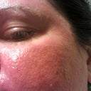This is 1 day post laser.  My skin became more red.