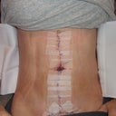 "After" - 1 day post op