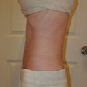 "After" - 4 days post op
