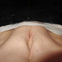 "Berfore" photo of diastasis with muscles flexed.  Actual diastasis was around 2 inches relaxed.