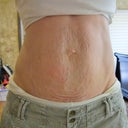 "Before" stretch marks
