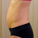 "Before" photo.  My muscles were not holding anything in.  I could tighten my abs and that belly would go away, but this was normal standing, relaxed position.  100 pounds, size 0-2.