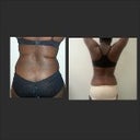 before and after back view 20 hours later