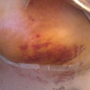 My left side is extremely tender!  I keep having to tell my daughter to be careful around mommy