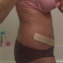 Day 26 - with the Scar Therapy Silicon Strips on - getting ready for work in the morning.  The treatment is very effective and minimally disruptive.