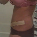 Day 26 - with the Scar Therapy Silicon Strips on - getting ready for work in the morning.  The treatment is very effective and minimally disruptive.