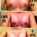 1 day PO...1wk PO...2week PO progress pics!!