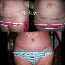 before and after ~ after photo taken 3 weeks post op ~ wow makes me cry ~ LOVE the NEW me :)
