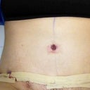 My new Belly Button...I think it looks kinda funky (maybe too small or too high). I guess I just got to get used to it.