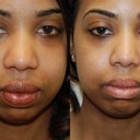 Lip Reduction Surgery.