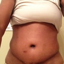 60 days PO; still a bit swollen but mostly later in the day