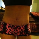 21 days PO, I just took off my binder, so I have some marks from that.. other wise i think it looks pretty good!  Wondering  if the swelling goes down will my stretch marks look less noticeable.