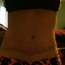 21 days PO, again, most of the marks are from the binder.. Since I've been massaging my tummy, incision ridge has gone down.  Very happy so far!