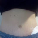 Day 24 post-op (original surgery) and Day 11 post-op from re-surgery.