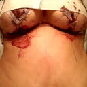 Just a couple hours after surgery. Breast implant removal with lift and No replacement implant.
dated 3/8/2012