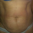 I asked my plastic surgeon if he could make a purse out of it..lol
