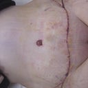 Day 3 Post Op!